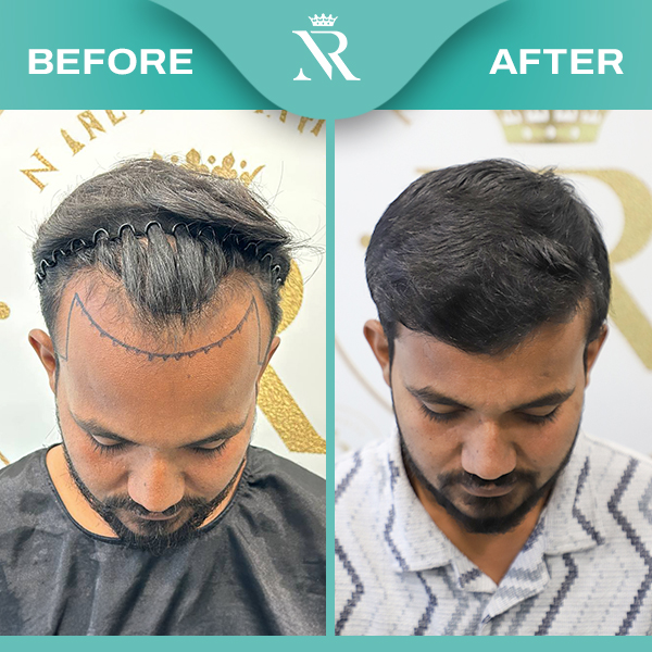 Hair Transplant