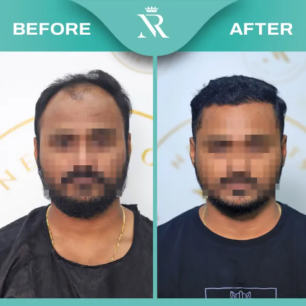 Hair Transplant