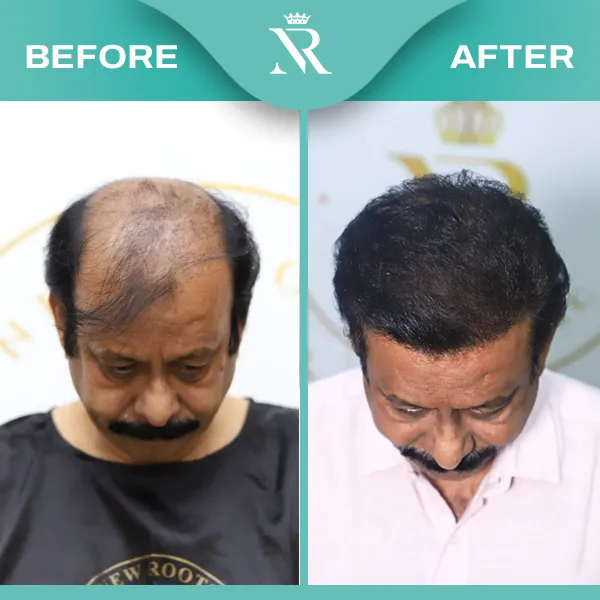 Hair Transplant