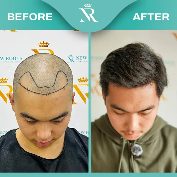 Hair Transplant