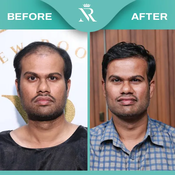 Hair Transplant