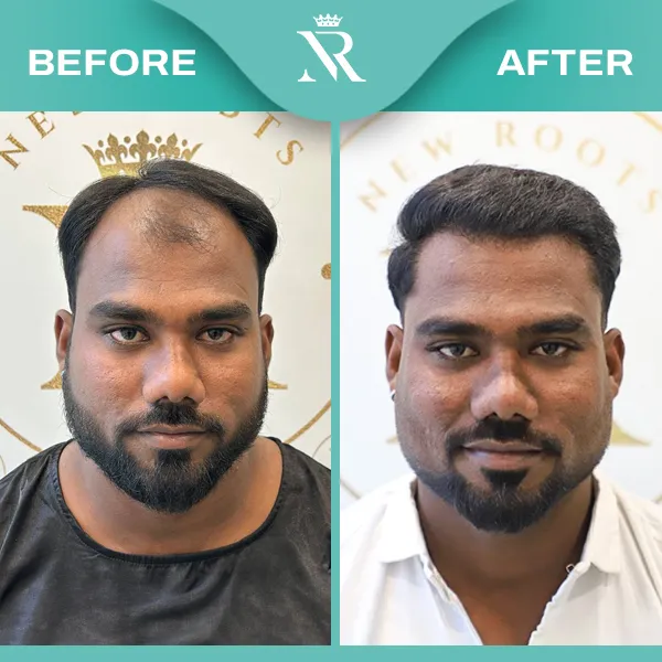 Hair Transplant
