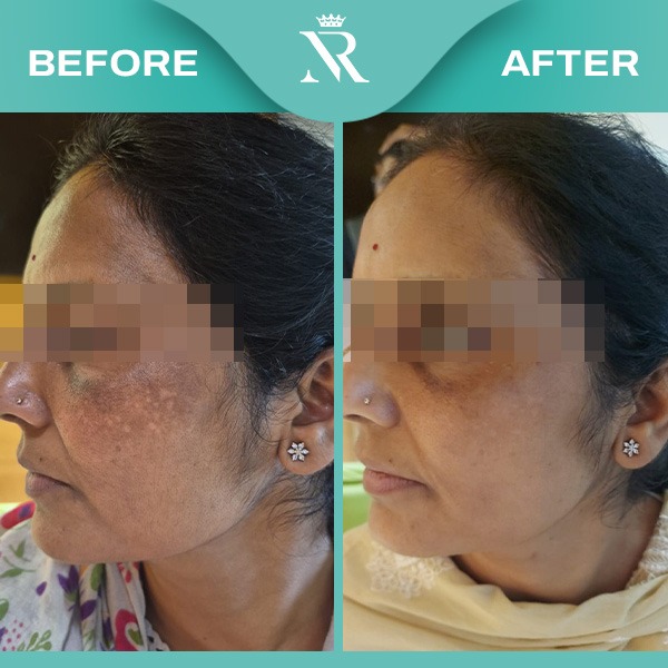 Skin Result